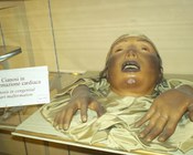 Cianosi da malformazione cardiaca