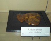 Cirrosi epatica