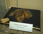 Tumore al fegato